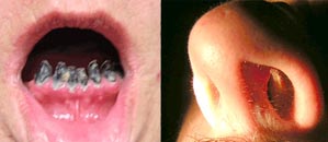pokodenie stnej a nosovej dutiny nupanm kokanu
