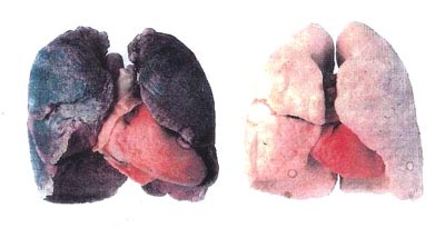porovnanie pc a srdca fajiara (vavo) a nefajiara (vpravo)